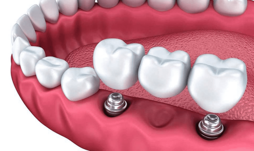 Implant Bridge