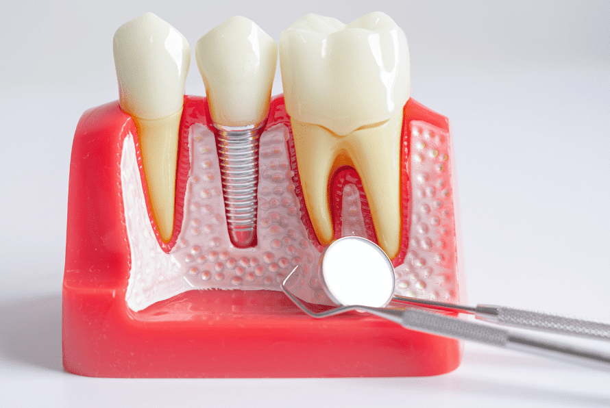 same-day implant fort lauderdale