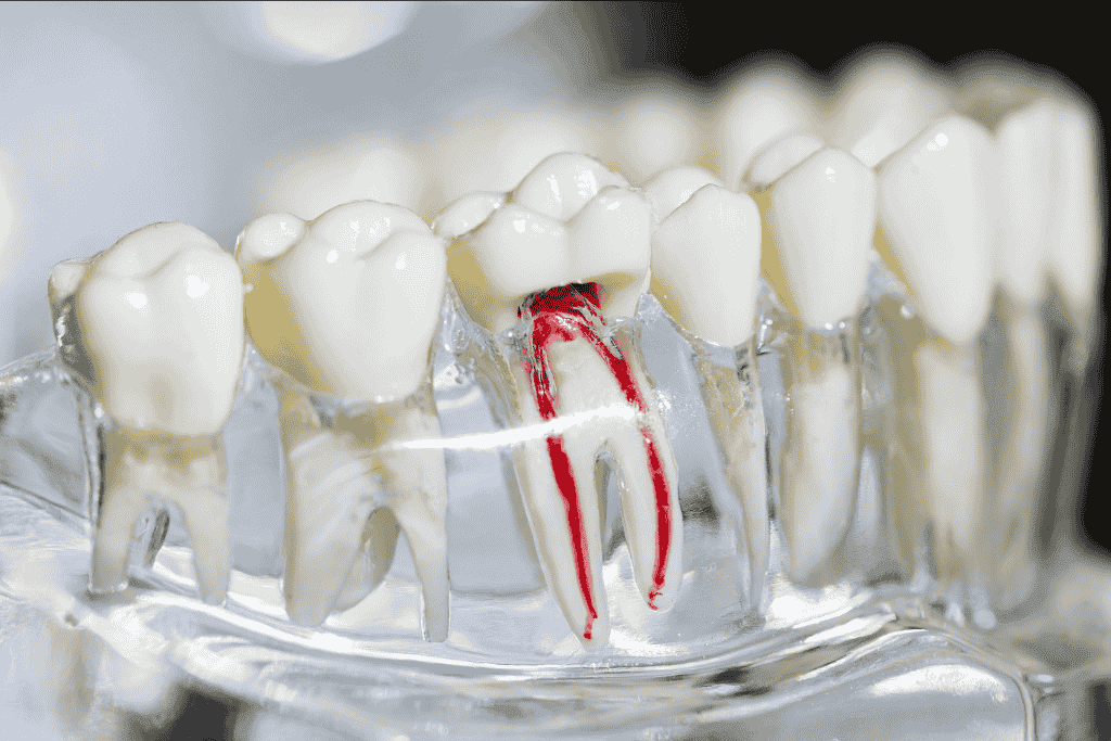 Root Canal Treatment Near Me | Fort Lauderdale Dental Clinic