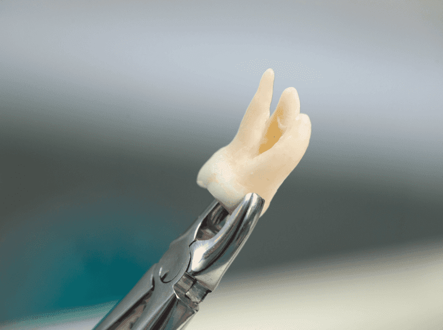 tooth extraction - Fort Lauderdale Dental Aesthetic Center