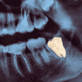 Wisdom Tooth Removal