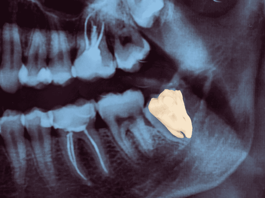 Wisdom Teeth Removal - Fort Lauderdale Dental Aesthetic Center