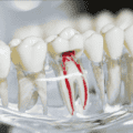 Root Canal Treatment