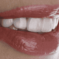 Veneers