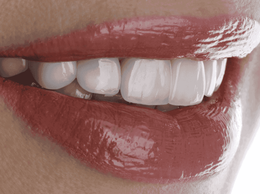 Veneers - Fort Lauderdale Dental Aesthetic Center