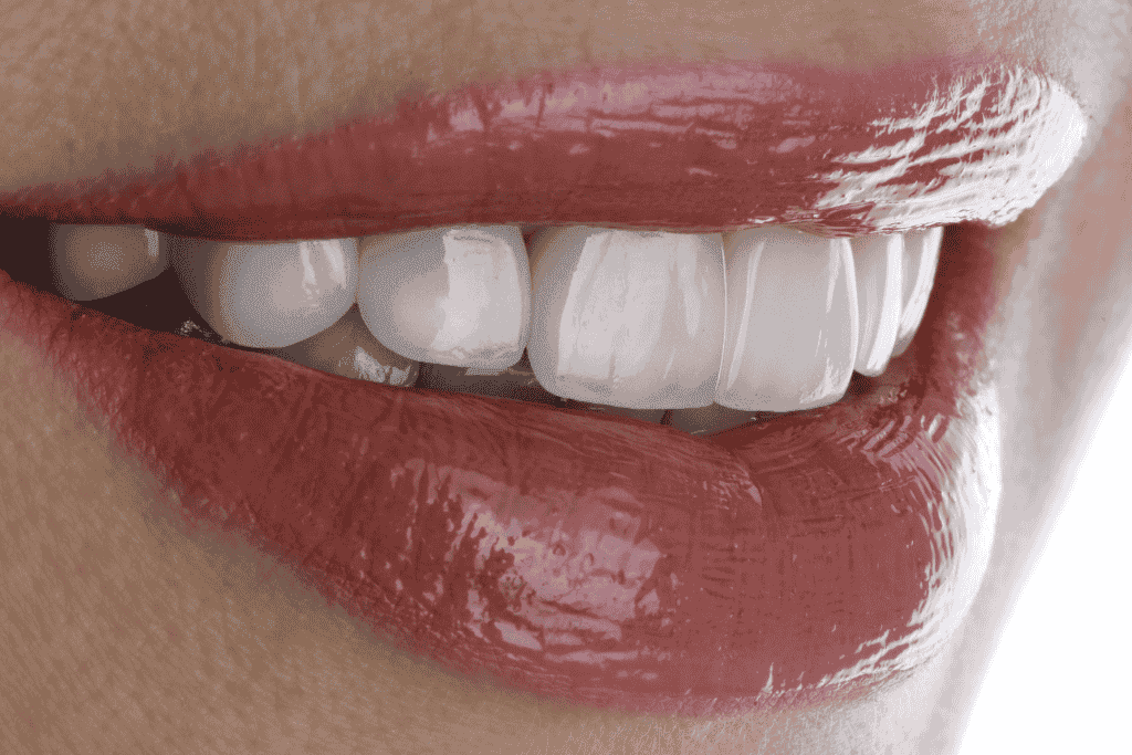 Veneers - Fort Lauderdale Dental Aesthetic Center