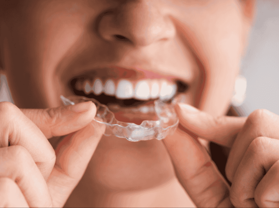 Invisible Aligners - Fort Lauderdale Dental Aesthetic Center