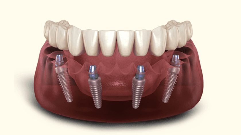 All-on-4 - Fort Lauderdale Dental Aesthetic Center